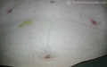 17-days-after-surgery.jpg