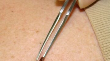 The Easiest & Best Way To Remove A Tick From Your Body Or Your Dog’s Body (…Even Very Tiny Ticks!)