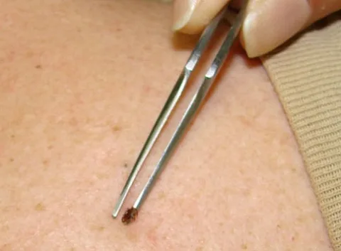 Using  pointy tweezers is the best way to remove a tick. But I will show you a few other easy ways to remove ticks as well.
