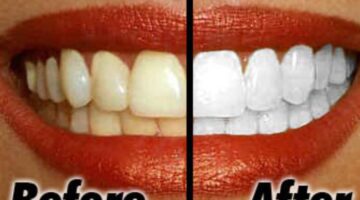 Teeth Whitening: DIY vs. Professional Treatments Compared