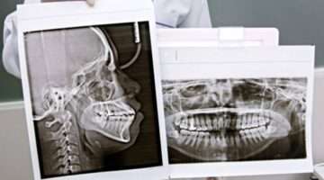 Best TMJ Treatment Options Without Surgery or Implants